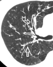 COPD Severity and Phenotype CT and pulmonary function Quantitative CT provides accurate information about parenchymal destruction and airways disease Both mechanisms concur to determine the overall