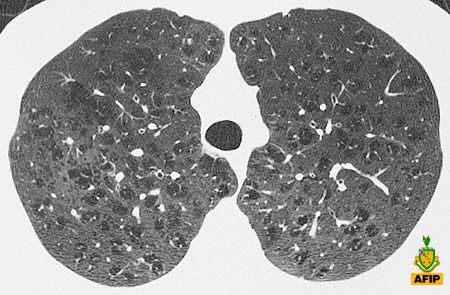 ENFISEMA CENTROLOBULARE POTERE DI RISOLUZIONE