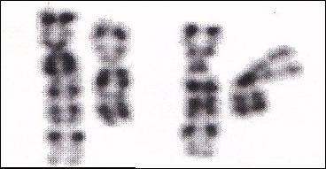 Famiglia 3: t (4;11) (q21;q23) III-3 probando Traslocazione che coinvolge il cromosoma 4, relativamente con bassa densità genica, e il cromosoma 11 contenente loci sottoposti ad imprinting con loro