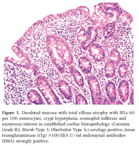 Mucosa intestinale patologica Lesione 1 (infiltrativa): villi morfologicamente nei limiti (rapporto 3:1),