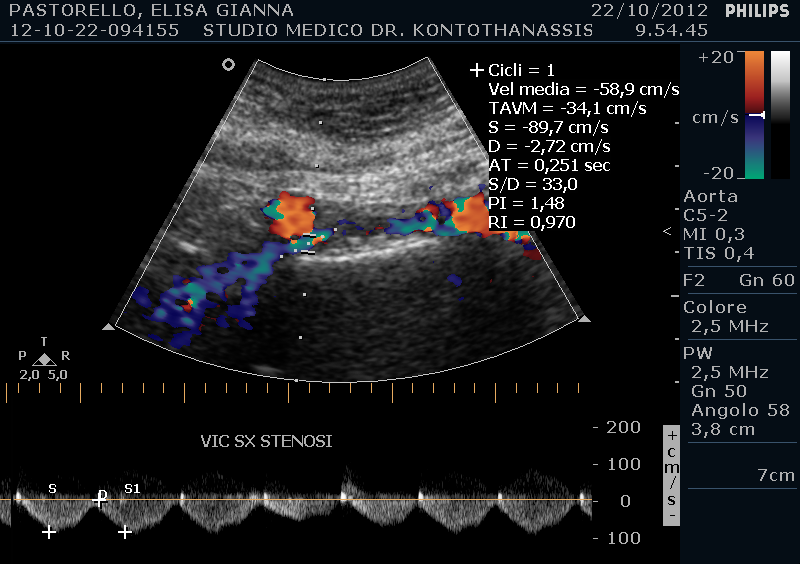 Tutti i pazienti erano sintomatici: quattro pazienti presentavano segni di IVC e di questi uno era stato trattato chirurgicamente prima che venisse posta diagnosi della sindrome; due pazienti