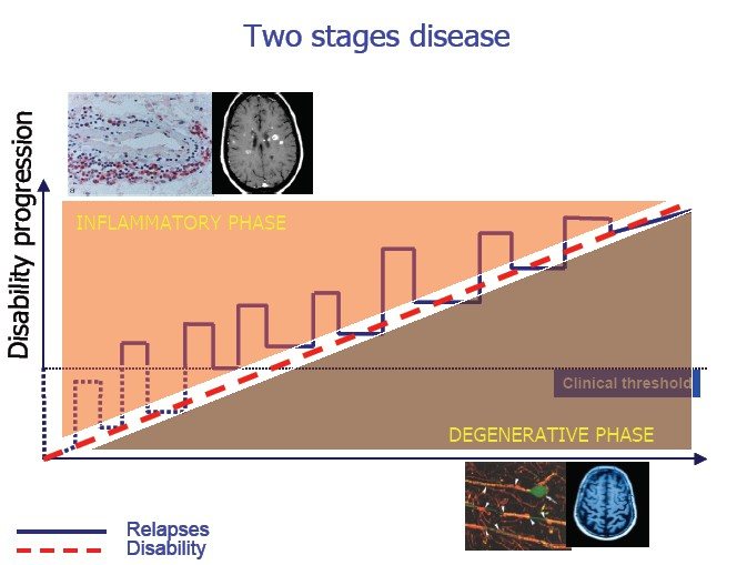 Una malattia in 2 stadi Inflammatory phase CIS