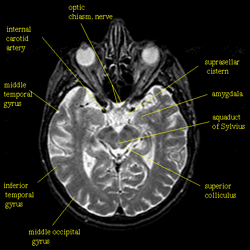 Modelli Anatomo-fisiologici e disordini visuopercettivi Sistema Visivo Occipito-temporale (via ventrale o del what : competente per la visione di oggetti cioè di riconoscimento degli stimoli.