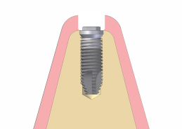 VITE A SFERA Per le protesi mobili vengono usate le viti a sfera. Queste vengono usate per overdenture su impianti e tessuti, solitamente con due o più impianti piuttosto paralleli (entro i 10 ).