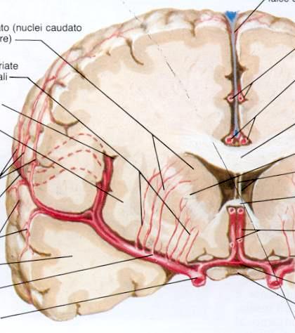 Infarto lacunare- malattia dei piccoli vasi Infarto di piccole dimensioni (<15 mm) localizzato nel territorio