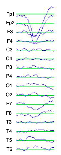 16 Brain-Computer Interface Figura 1.10: Tracciati EEG influenzati da artefatti.