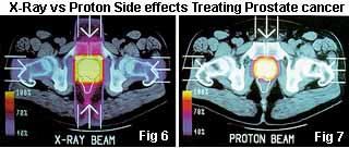 Proton radiation therapy 49 Domenico Campi -