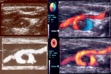 a b Placcche ateromasiche iperecogene e miste: a) B/N; b) evidenziate con l d l Megadolico arterie Sono tortuosità vasali