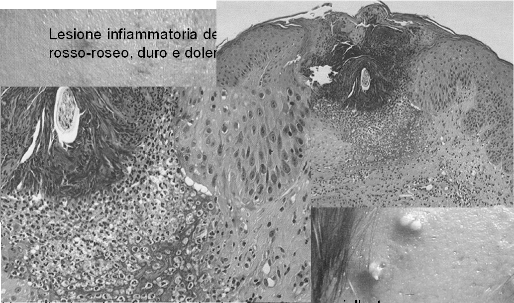 12/11/2012 Lesioni infiammatorie Papula Pustola Nodulo Seni drenanti Papula e pustola Follicolite suppurativa con perifollicolite Lesione infiammatoria del diametro di solito inferiore a 5mm, di