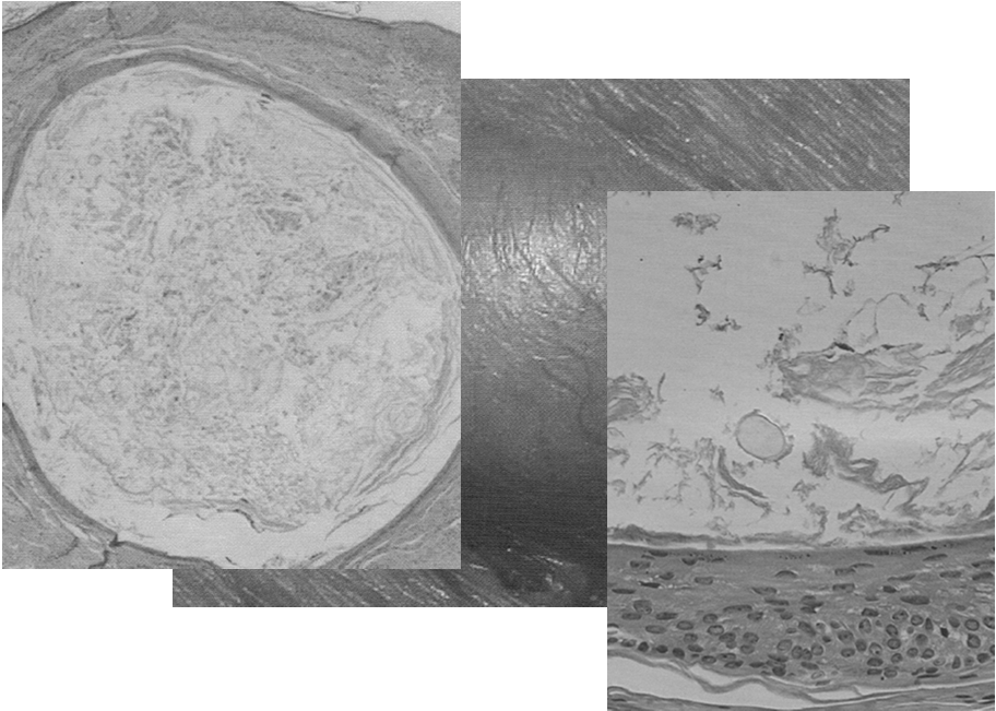 Cisti Lesioni post-infiammatorie Cicatrici Cisti Cavità delimitata da epitelio squamoso pluristratificato e ripiena di materiale cheratinico Nodulo di consistenza duro-elastica, di 0,5-5cm di