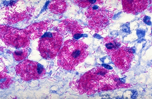 Colorazione di Ziehl-Neelsen Osservazione microscopica Gli organismi acido-resistenti (AFB=acid