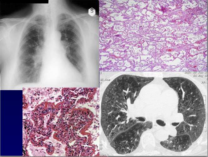 La TAC, però, mostra delle alterazioni reticolo-nodulari dei canali bronchiali, soprattutto a destra.