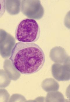 LEUCEMIA PROLINFOCITICA (> 55%