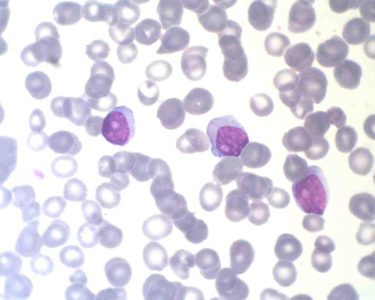 Linfocitosi elevate Anemia neutropenia Piastrinopenia