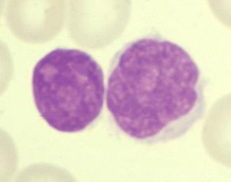 FASE LEUCEMICA DI LINFOMA MANTELLARE Forma classica CD19