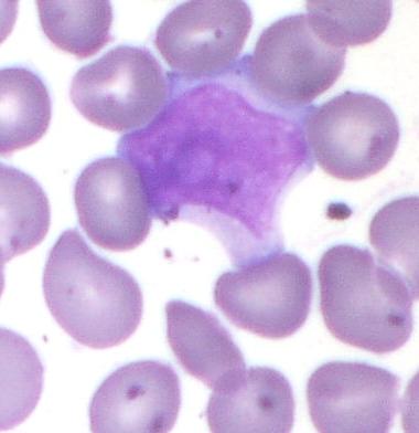 Linfoma non Hodghin a grandi cellule B leucemizzato