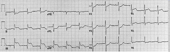 Esempi: TROPONINA All ECG sopraslivellamento ST