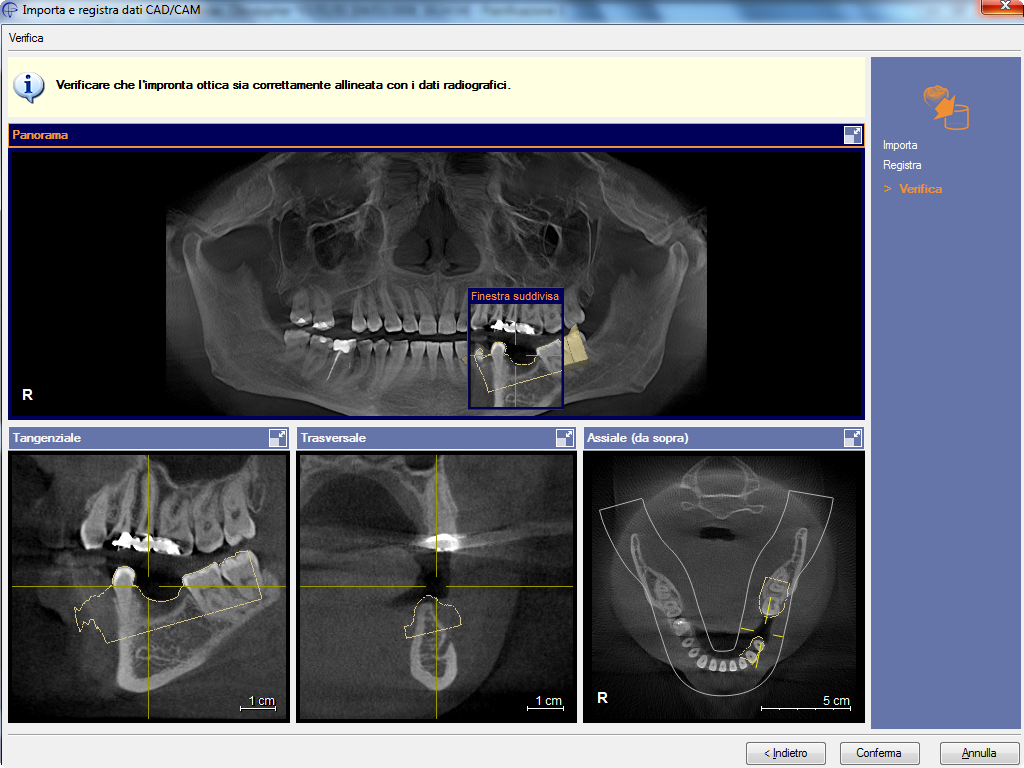 Appendice B. CAD/CAM B.3.3. Passaggio 3: Verifica della registrazione Verificare il risultato della registrazione e confermare che l'impronta ottica sia allineata correttamente ai dati radiografici.