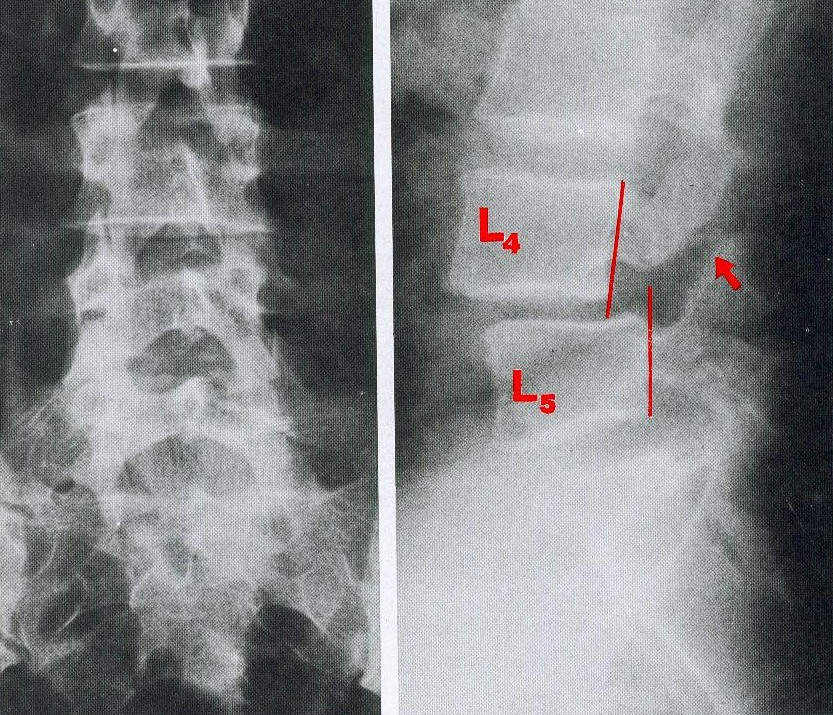 LOMBOSCIATALGIA DIAGNOSTICA STRUMENTALE