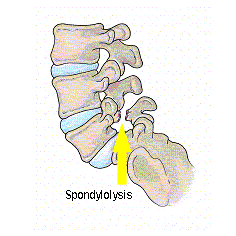 Spondilolisi e spondilolistesi La spondilolisi colpisce la V vertebra lombare per il 70-80% dei casi, ed è spesso seguita da spondilolistesi.