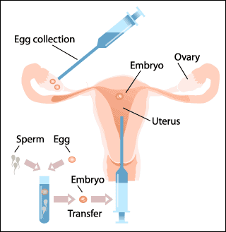 Tecniche di procreazione medicalmente assistita (PMA) FIVET (Fertilizzazione in vitro con Embryo Transfer) Efficace Raccomandata quando entrambe le