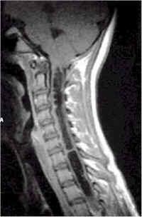 SIRINGOMIELIA Patologica formazione di una o più cavità nel midollo spinale, orientata lungo il suo asse maggiore.