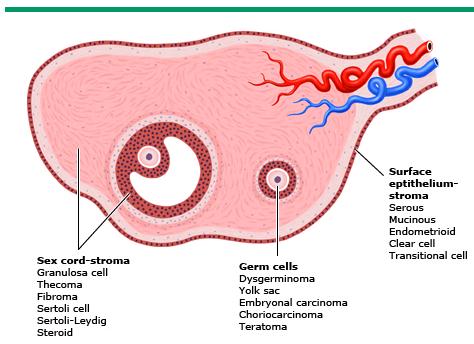 TUMORI ANDROGENO-SECERNENTI Neoplasie dell ovaio: Benigne: originano dalla superficie epiteliale, stromale, dai cordoni sessuali e dalle cellule germinali (cistoadenoma sieroso e mucinoso,