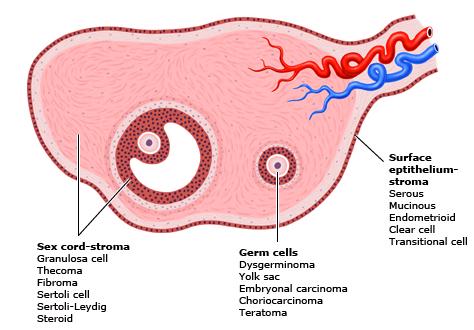 Le forme maligne sono rare (1.2% dei tumori ovarici primitivi) e sono considerate generalmente a basso grado di malignità.