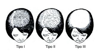 INDICE DI FERRIMAN&GALLWAY Tipo I, l alopecia si presenta con un diradamento in tutta la parte superiore del cuoio capelluto, anche se la linea frontale dei capelli non viene afflitta dal problema.