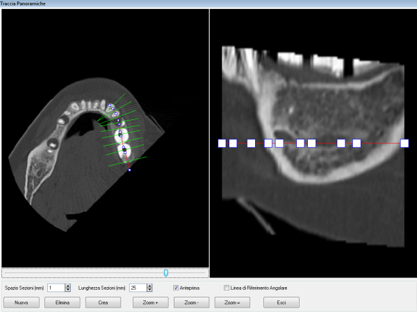 tracciare una nuova panoramica per l'esecuzione della simulazione implantare: oppure tracciare una panoramica che passa al centro dei punti di repere presenti sulla dima radiologica: Una volta creata