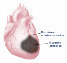 12 Cardiopatia ischemica L'infarto miocardico acuto presenta un dolore improvviso, spesso a riposo o nel sonno, a volte brevi precordialgie si sono manifestate nei