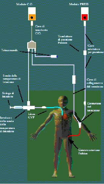 Sistema PiCCO Pulse-induced Contour Cardiac Output Rilevazione Attraverso il CVC si inietta in atrio dx un liquido di cui si conosce il volume e la temperatura (oltre12 C inf. a temp.