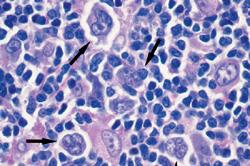 LH nodulare a predominanza linfocitaria Caratterizzato da proliferazione polimorfa nodulare o nodulare e diffusa di grandi cellule neoplastiche disseminate (popcorn cell) 5% dei LH Età mediana: 30-50