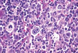 LH cellularità mista Cellule neoplastiche numerose e ben evidenti, non si osservano fibrosi o noduli ben formati 20-25% dei LH Età mediana: 37 70% sesso maschile Mixed