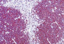 LH ricco di linfociti Caratterizzato da diffusa proliferazione di piccoli linfociti per lo più T commista a numerose cellule H-RS a tipica morfologia.