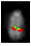 Analisi su nuclei in metafase di un traslocazione cromosomica t(11;14)(q13;q32) in linfoma