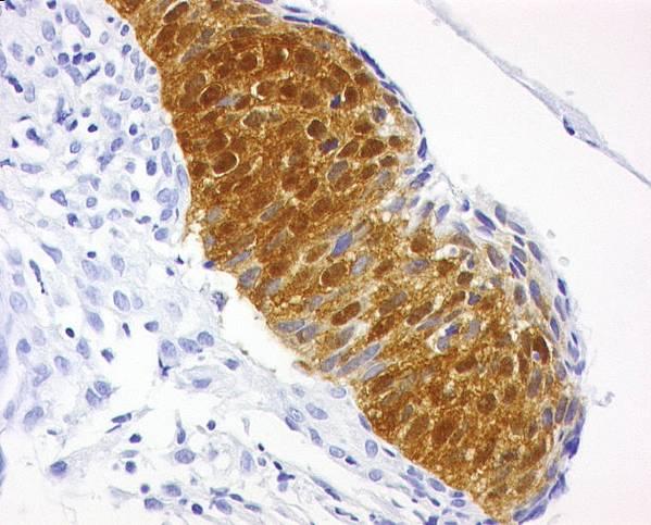 L espressione della proteina p16 e di Rb/p130 è stata