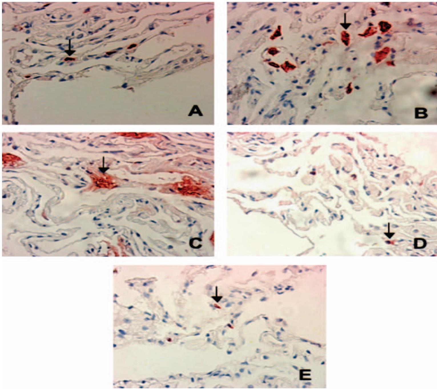 DISTAL LUNG INFLAMMATION IN ASTHMA a)