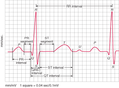 2.2 Tracciato elettrocardiogramma L'elettrocardiogramma (ECG) è il tracciato ottenuto mediante l'elettrocardiografo, che registra l'attività del cuore tramite elettrodi applicati in diversi punti del