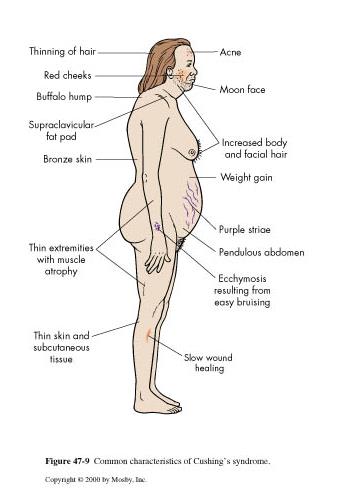 SINDROME DI CUSHING Aumento di peso Ipertensione Diabetes/intolleranza glucidica Depressione Gravidanza?