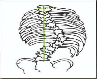 TraumaCad Manuale dell'utente Angolo d'inclinazione di T1 L'angolo tra una linea tracciata lungo la placca terminale superiore di T1 fino e una linea perpendicolare all'asse verticale della