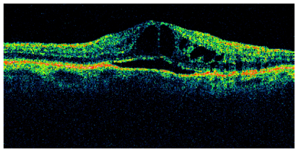 La retinopatia diabetica proliferante si evidenzia all OCT per la presenza di membrane epiretiniche altamente riflettenti situate anteriormente alla superficie retinica e formate da una