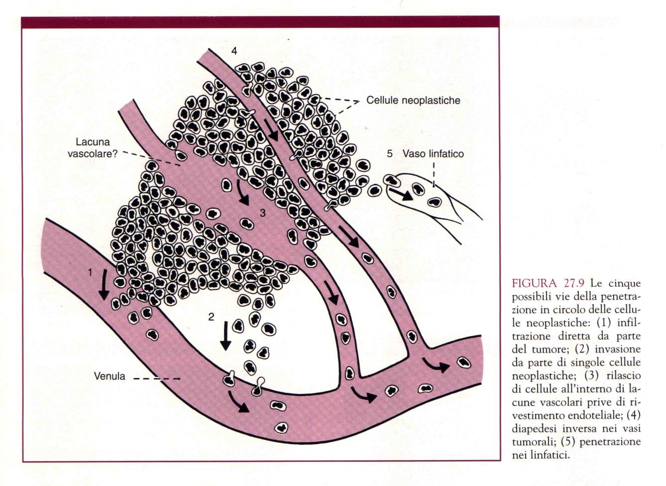 I meccanismi della metastasi Le vie della penetrazione in circolo delle cellule neoplastiche: 1. Infiltrazione diretta da parte del tumore 2. Invasione da parte di singole cellule 3.