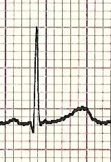 Modello Adulto Asse elettrico dopo il I anno Normale inferiore a 100 Asse QRS Valori normali per età I^ sett.