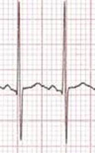 Intervallo QT È misurato dall inizio del QRS al termine della T, onda U esclusa Formula di Bazett QTc= QT/ RR (in sec) II-V5-V6 sono le derivazione che meglio si prestano alla misurazione QTc 1-16