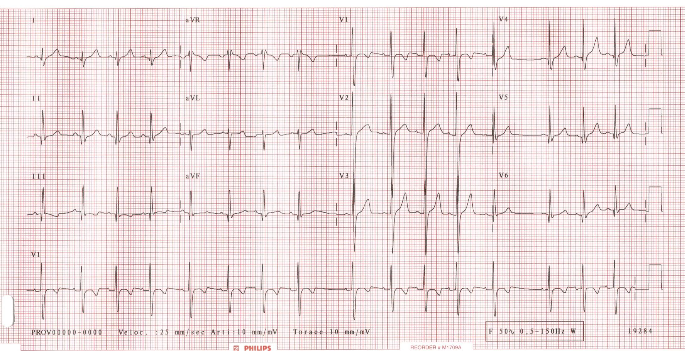 ritmo cardiaco è sotto il controllo del vago Segno di buona