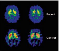 Parkinsonismo iatrogeno - Neuroimaging I DRBAs hanno una scarsa/nulla affinità per il DAT.