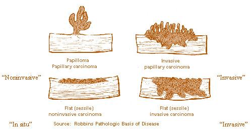 Neoplasie della vescica Morfologia PAPILLOMA NON INVASIVO