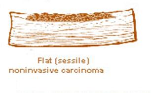 ALTERAZIONI DELLA PARETE Tumore a cellule transizionali Forme