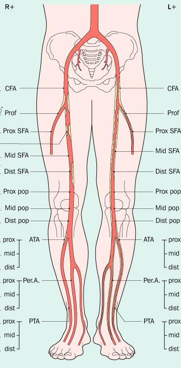 DEFINIZIONE: L arteriopatia obliterante è caratterizzata dal progressivo restringimento delle arterie fino all ostruzione completa delle stesse.